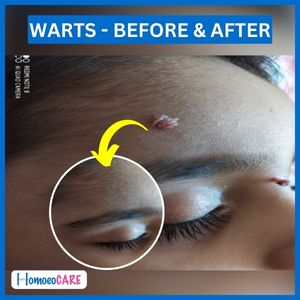 Before and after image of warts on eyelids 